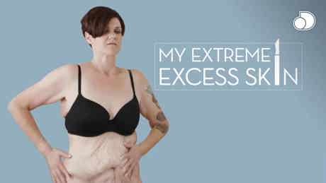 My Extreme Excess Skin S2 2017